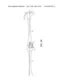 EXTRAMEDULLARY RESECTION GUIDE AND METHODS diagram and image