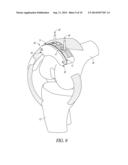 EXTRAMEDULLARY RESECTION GUIDE AND METHODS diagram and image