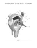 INTRAMEDULLARY RESECTION GUIDE AND METHODS diagram and image