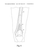 CUSTOMIZED PATIENT-SPECIFIC REVISION SURGICAL INSTRUMENTS AND METHOD diagram and image