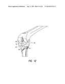 TIBIAL RESECTION SYSTEMS AND METHODS FOR CRUCIATE LIGAMENT RETAINMENT diagram and image