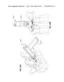 Methods and Apparatus for Insertion of Implant Material diagram and image