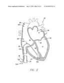 TEMPORARY LEADLESS IMPLANTABLE MEDICAL DEVICE WITH INDWELLING RETRIEVAL     MECHANISM diagram and image