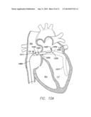 TEMPORARY LEADLESS IMPLANTABLE MEDICAL DEVICE WITH INDWELLING RETRIEVAL     MECHANISM diagram and image