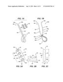 Implant Having Adjustable Filament Coils diagram and image