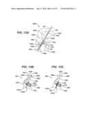 Implant Having Adjustable Filament Coils diagram and image