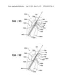 Implant Having Adjustable Filament Coils diagram and image