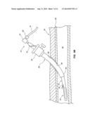 TEMPORARY SEALING DEVICE WITH BLOOD FLASHBACK FOR VESSEL LOCATION diagram and image