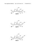 MEDICAL DEVICE FOR TREATING A TARGET SITE diagram and image