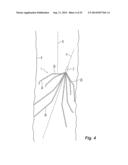 Embolus Blood Clot Filter Delivery System diagram and image