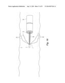 Embolus Blood Clot Filter Delivery System diagram and image