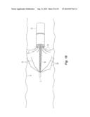 Embolus Blood Clot Filter Delivery System diagram and image