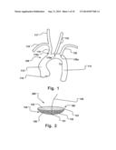 Temporary Embolic Protection Device And Medical Procedure For Delivery     Thereof diagram and image