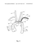 Temporary Embolic Protection Device And Medical Procedure For Delivery     Thereof diagram and image