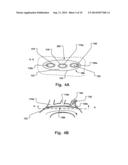 Temporary Embolic Protection Device And Medical Procedure For Delivery     Thereof diagram and image