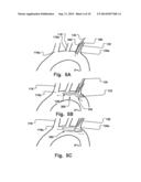 Temporary Embolic Protection Device And Medical Procedure For Delivery     Thereof diagram and image