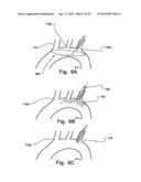 Temporary Embolic Protection Device And Medical Procedure For Delivery     Thereof diagram and image