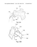 Temporary Embolic Protection Device And Medical Procedure For Delivery     Thereof diagram and image