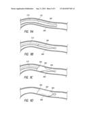 BLOOD VESSEL OCCLUSION diagram and image