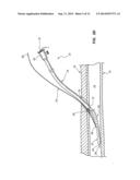 DISTAL RAPID EXCHANGE FOR TRANSLUMINAL ANGIOPLASTY DEVICE AND METHODS diagram and image