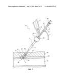 ACTIVE SECUREMENT DETACHABLE SEALING TIP FOR EXTRA-VASCULAR CLOSURE DEVICE     AND METHODS diagram and image