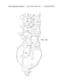 PERCUTANEOUS BREAK OFF ROD diagram and image