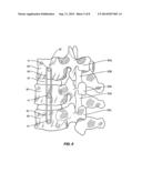 METHODS FOR CORRECTING SPINAL DEFORMITIES diagram and image