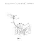 PERCUTANEOUS ROD INSERTER diagram and image