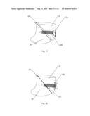 SHAPE CHANGING BONE IMPLANT AND METHOD OF USE FOR ENHANCING HEALING diagram and image