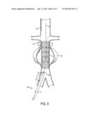 STENT DELIVERY SYSTEM AND METHOD diagram and image