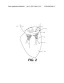 TRANSCATHETER VALVE REPLACEMENT diagram and image