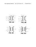 TRANSCATHETER VALVE REPLACEMENT diagram and image