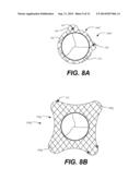 TRANSCATHETER VALVE REPLACEMENT diagram and image