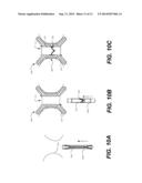 TRANSCATHETER VALVE REPLACEMENT diagram and image