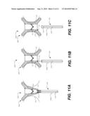 TRANSCATHETER VALVE REPLACEMENT diagram and image