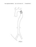 METHOD OF CONTROLLED RELEASE AND SUBSEQUENT DEPLOYMENT OF A PERCUTANEOUS     REPLACEMENT HEART VALVE diagram and image