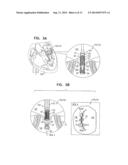 PERCUTANEOUS MITRAL VALVE REPLACEMENT AND SEALING diagram and image