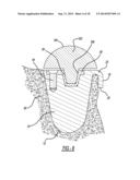 Modular Glenoid Base plate With Augments diagram and image