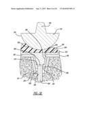 Modular Glenoid Base plate With Augments diagram and image