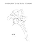 Modular Glenoid Base plate With Augments diagram and image