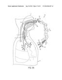 ASPIRATION CATHETERS, SYSTEMS, AND METHODS diagram and image