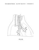 ASPIRATION CATHETERS, SYSTEMS, AND METHODS diagram and image