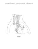 ASPIRATION CATHETERS, SYSTEMS, AND METHODS diagram and image