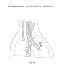 ASPIRATION CATHETERS, SYSTEMS, AND METHODS diagram and image