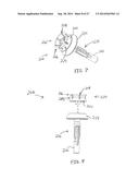 METHOD AND APPARATUS FOR SEALING END-TO-END ANASTOMOSIS diagram and image