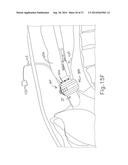 METHOD AND APPARATUS FOR SEALING END-TO-END ANASTOMOSIS diagram and image