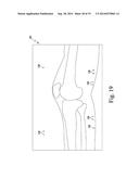 APPARATUS AND METHOD FOR CALIBRATING AN X-RAY IMAGE OF A KNEE OF A PATIENT diagram and image