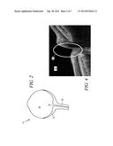 OPTIC DISC IMAGE SEGMENTATION METHOD AND APPARATUS diagram and image