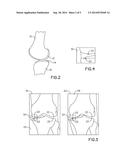 INTERACTIVE METHOD TO ASSESS JOINT SPACE NARROWING diagram and image