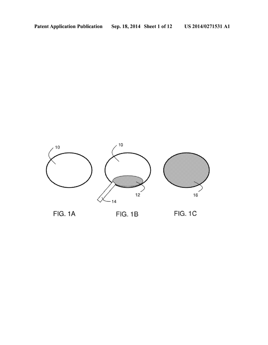 In-Situ Forming Foam for Endoscopic Lung Volume Reduction - diagram, schematic, and image 02